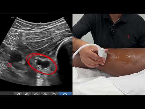 IPACK Block - Medial In-Plane Insertion