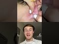 Extreme Ear Pimple Pop | Skin Info Ken #shorts