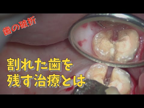 生命歯学科 歯が割れてしまっても残す方法があります！割れた歯を残す接着治療について解説します!