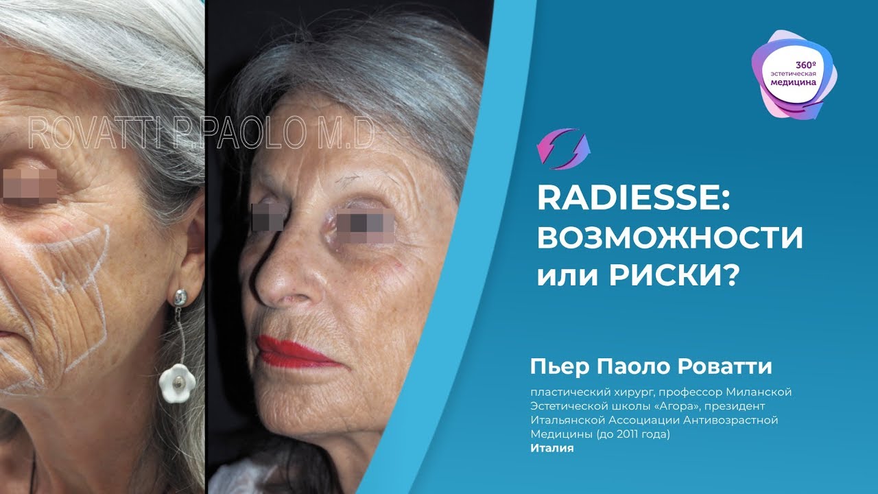 Radiesse: возможности или риски?