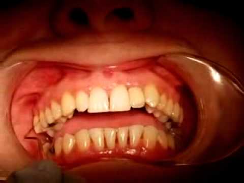 Podstawowe badanie periodontologiczne (BPE) - sondowanie