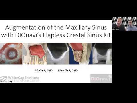 Maxillary Sinus Grafting and the DIOnavi Guided Sinus Lift Kit