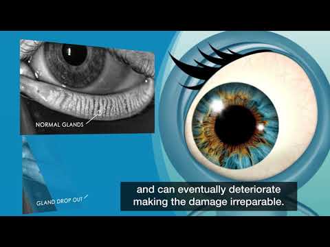 Dry Eye or MGD by Lipiflow (TearScience/Johnson&JohnsonVision)