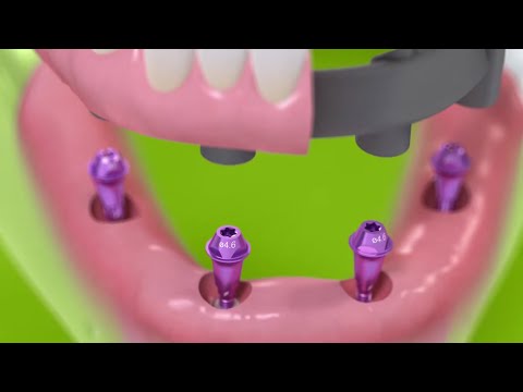 Straumann® Pro Arch BLX