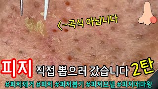 [問卦] 鼻子擠一擠一堆皮脂管絲正常嗎