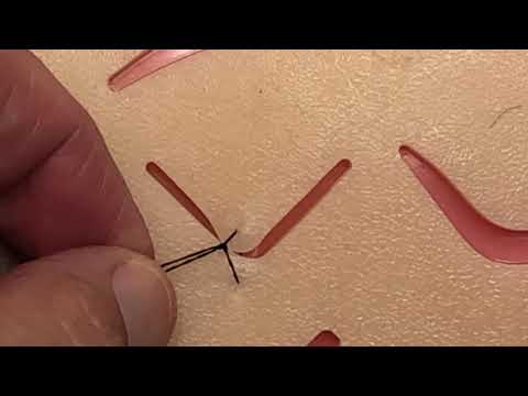 V-shaped laceration repair