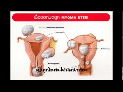 ฉันมี shishechka เล็ก ๆ น้อย ๆ บนหน้าอกภายใต้หัวนม การออกกำลังกายเพื่อเพิ่ม dumbbells เต้านม
