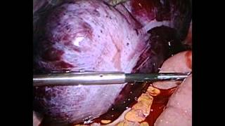 Cecal Volvulus Case Dr Ferzli Cecal Volvulus Case Dr Ferzli