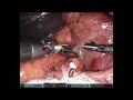 『達文西手術』胰十二指腸切除手術 Robotic Whipple Operation (Resection)