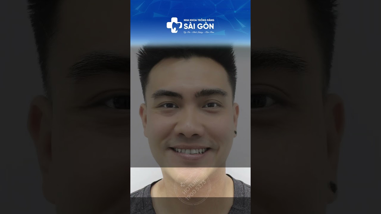 Case Dán Sứ - Veneer 20 Răng Trắng Sáng, Tự Nhiên | Nha Khoa Trồng Răng Sài Gòn  #veneers