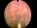 A Bizarre urethral lesion: what is this?