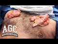 Massive Gynecomastia Male Breast Removal Procedure