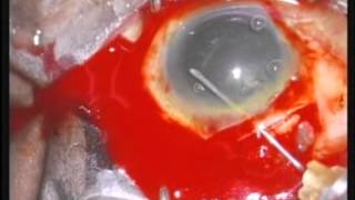 MSICS (black cataract) performed by Glenn Strauss, M.D. CMO for Help Me See