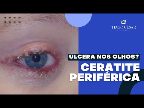 Ceratite Periférica | Úlceras Periféricas | Blefarite | Dr. Tiago César
