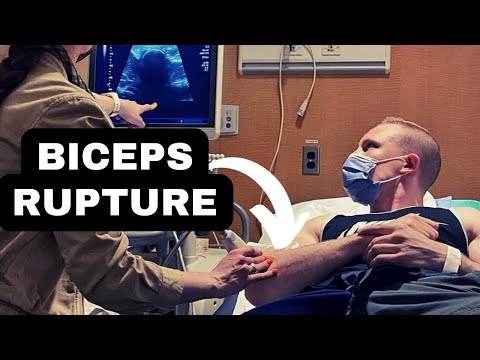 My Distal Bicep Tear Recovery After Tendon Repair Surgery