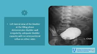 Core Videos (2025): Posterior Urethral Valve Voiding Cystourethrogram