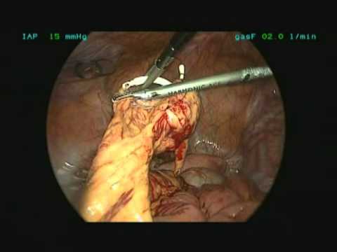 Laparoskopowe Usunięcie Przemieszczonej Wkładki Wewnątrzmacicznej (IUD)