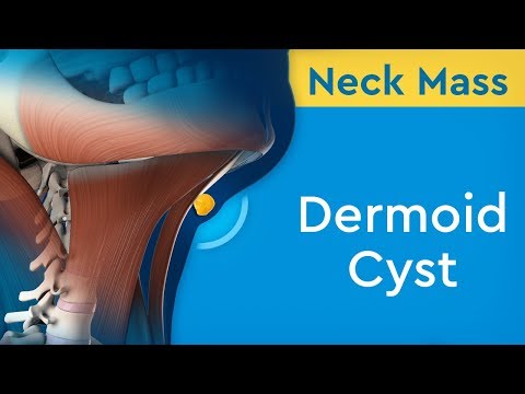 Neck Mass: Dermoid Cyst