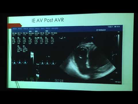 20180824_26_ Aortic_stenosis_and_Aortic_regurgitation_(case-based TEE evaluation) _Schup_Michael_Dr