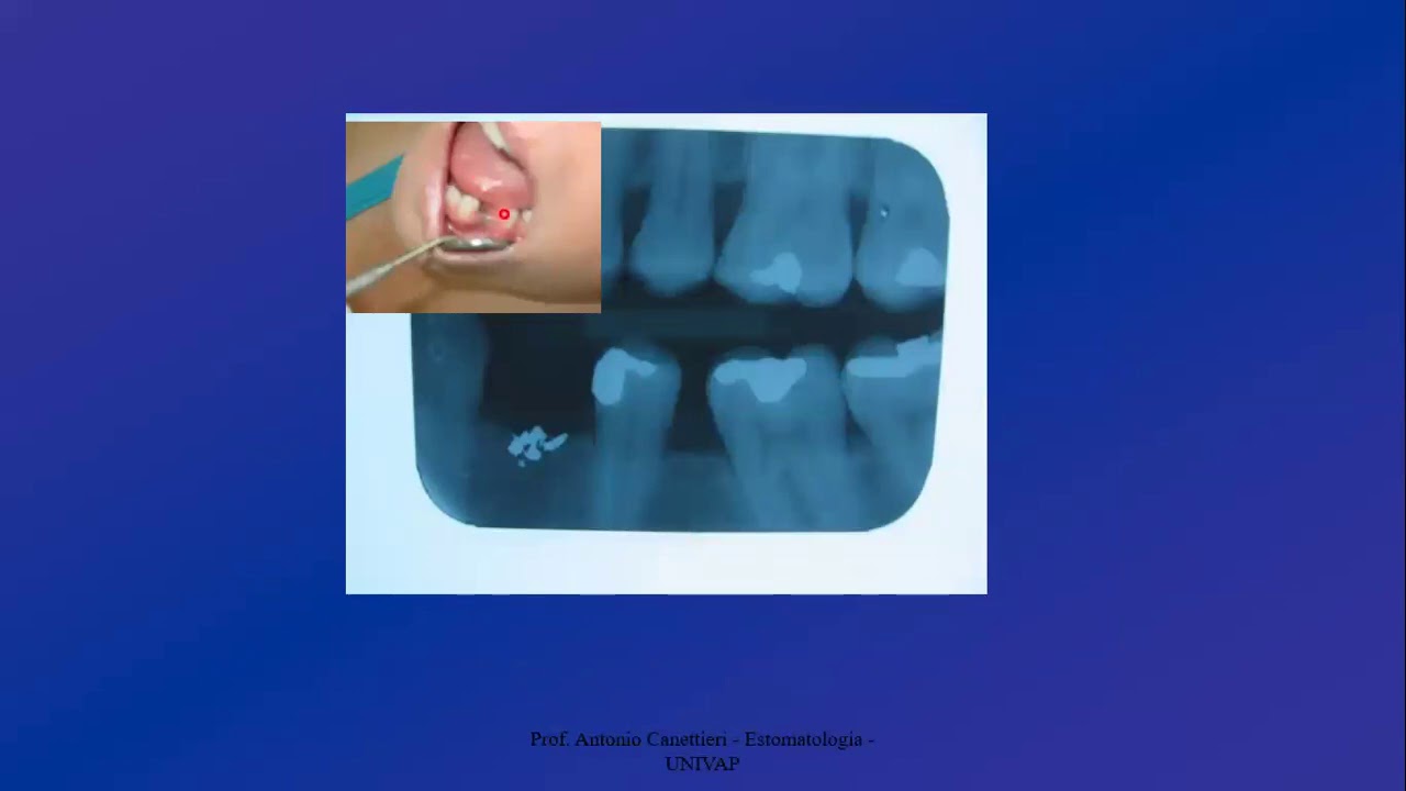 ESTOMATOLOGIA- Lesões pigmentadas
