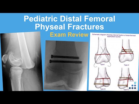 Pediatric Distal Femoral Physeal Fracture Exam Review - Eric Shirley, MD