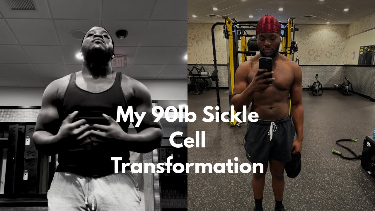 The Research Peptide That Helped Me Manage Sickle Cell & Lose 90lbs!
