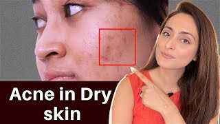 Acne in Dry Skin | what to use | serums, creams | Dermatologist recommends