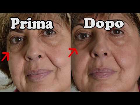 Acconciatura per il sollevamento di persona Si svegliò di mattina con gli occhi gonfiati