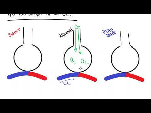 image-What is a VQ shunt?
