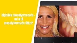 Digitális mosolytervezés - Mi a jó mosolytervezés titka?
