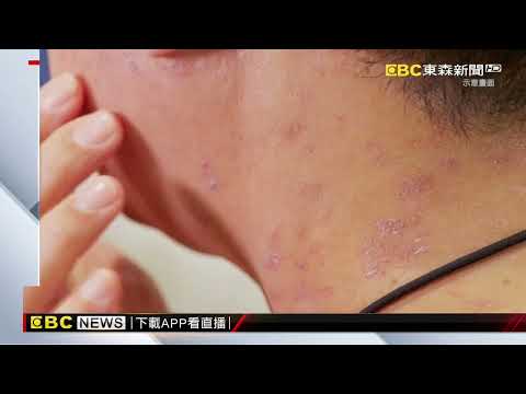 痛起來要人命! 王彩樺 林襄帶頭趕「皮蛇」