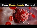 Thrombosis 3D Animation Deep Vein Thrombosis Symptoms Causes And Treatment Urdu Hindi