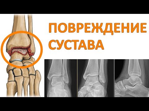 Лечение артроза голеностопного сустава: способы и методы
