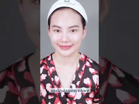 แก้จมูก เสริมคาง ดูดไขมันเหนียง EP.2 แก้จมูก เสริมคาง ดูดไขมันเหนียง EP.2