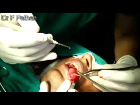 A torok papilloma átterjed