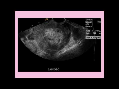 Endometritis - CRASH! Medical Review Series