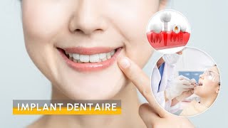 Implant dentaire ‐ Comment remplacer une dent manquante  Turquie Santé