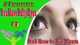 5 Reasons You Have Puffy Eyes And How to Fix Them | Care Health