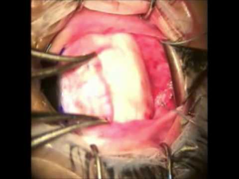 Squint surgery - Lateral rectus muscle fixation to orbital wall