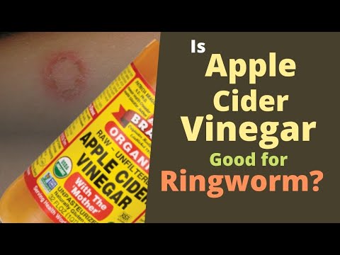 Apple Cider Vinegar for Ringworm [Does It Kill Ringworm?]