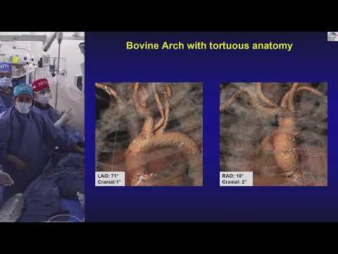 Live Case 1 and 2 Evolut R ViV SAPIEN 3 ViV TAVR Sentinel Device