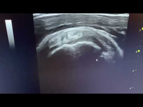 MSK ultrasound shoulder - Subscapularis long and short axis