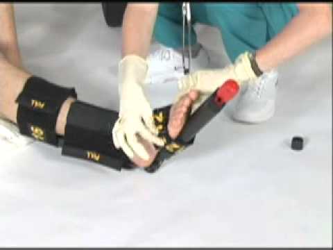 Introducing Sager Emergency Traction Splints and Fracture Response Systems (SEFRS)