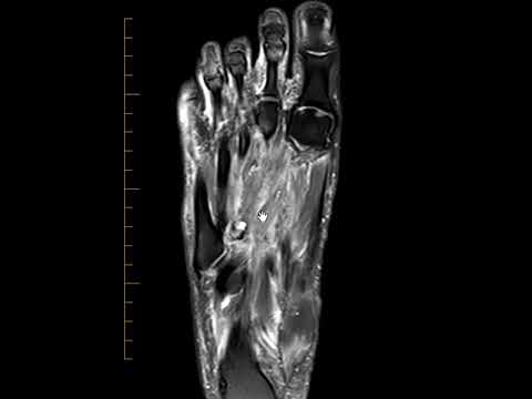 Lisfranc fracture-dislocation