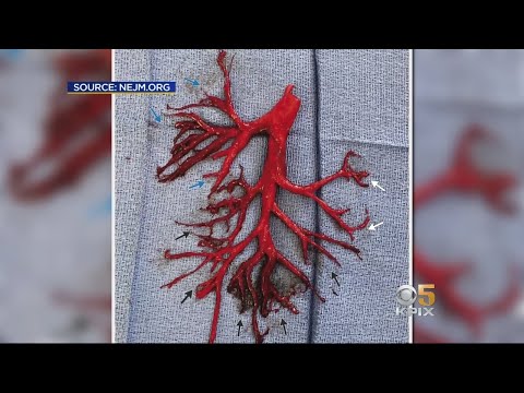Man Coughs Up 6-Inch Blood Clot in Shape of a Bronchial Tree, Dies