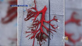 Man Coughs Up 6-Inch Blood Clot in Shape of a Bron