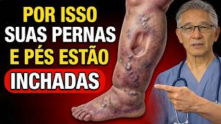 Pernas e Pés Inchados? Se a Marca do Dedo Não Sai, Você Precisa Ver Isso AGORA