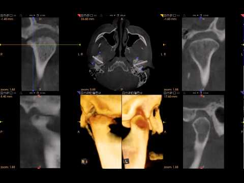 3-D Scan of TMJ