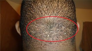 how to get rid of razor bumps on head