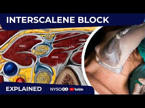 US-Guided Interscalene Brachial Plexus Block - Regional anesthesia Crash course with Dr. Hadzic